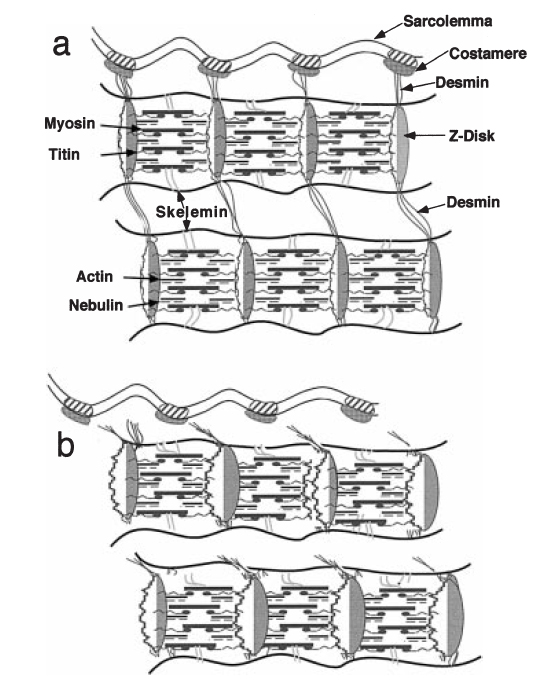  Схематическая диаграмма механизма разрушения Z-диска. (a) – нормальное расположение миофибрилл (b) смещение миофибрилл. Широкие Z-диски как свидетельство Z-дискового «размытия» в электронном микроскопе (по: J.Friden, R.L.Lieber, 2001).