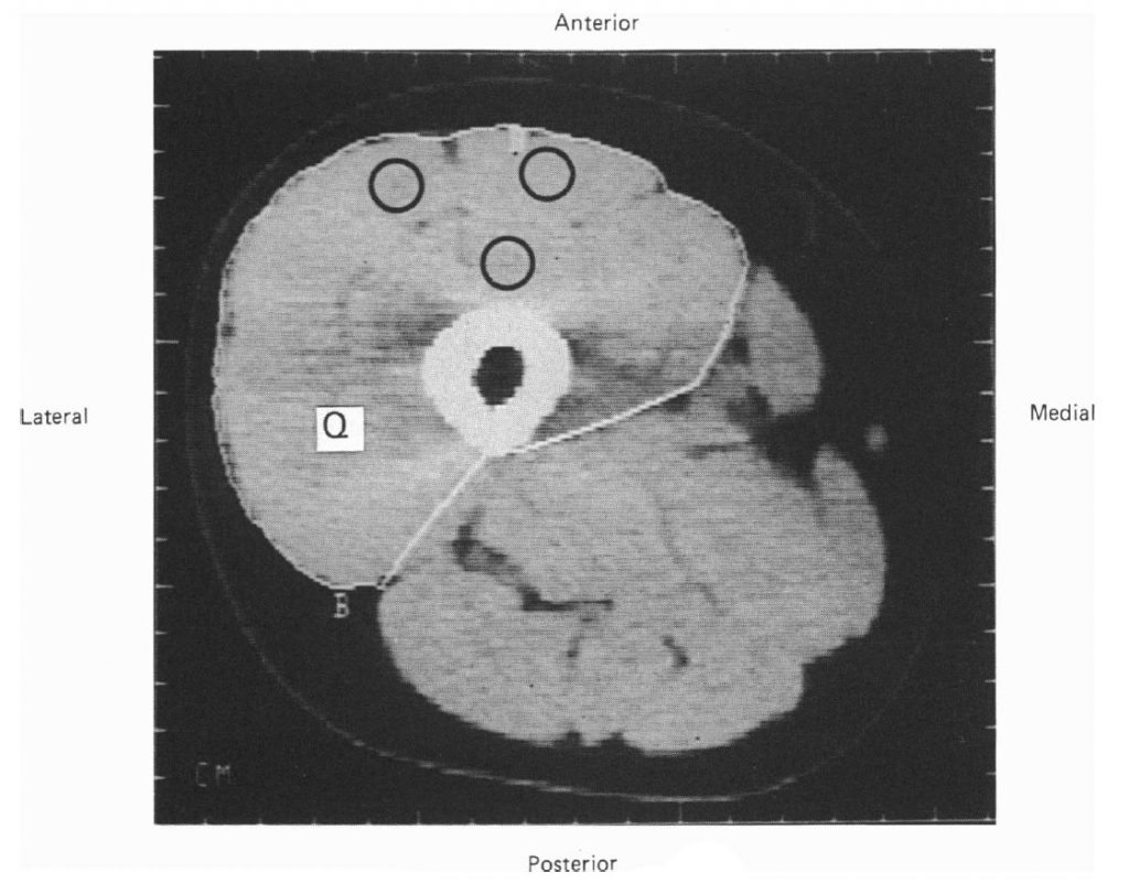 Изображение четырехглавой мышцы бедра (середина бедра) мужчины, выполненное посредством компьютерной томографии