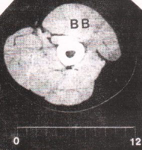 Компьютерная томография сгибателей плеча