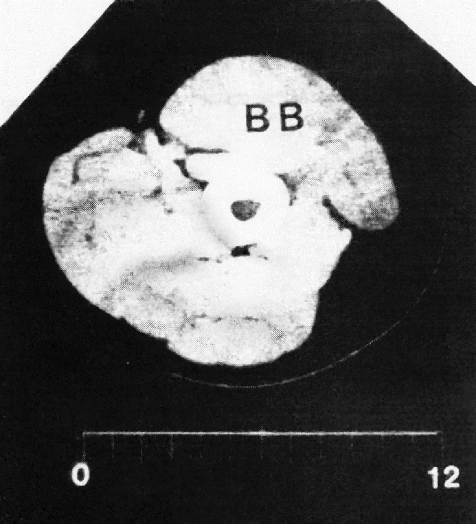 Рис_2 Компьютерная томография сгибателей предплечья