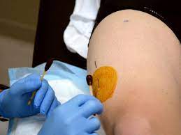 Биопсия четырехглавой мышцы бедра