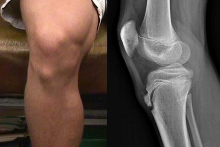 Миниатюра для записи Болезнь Осгуда-Шлаттера