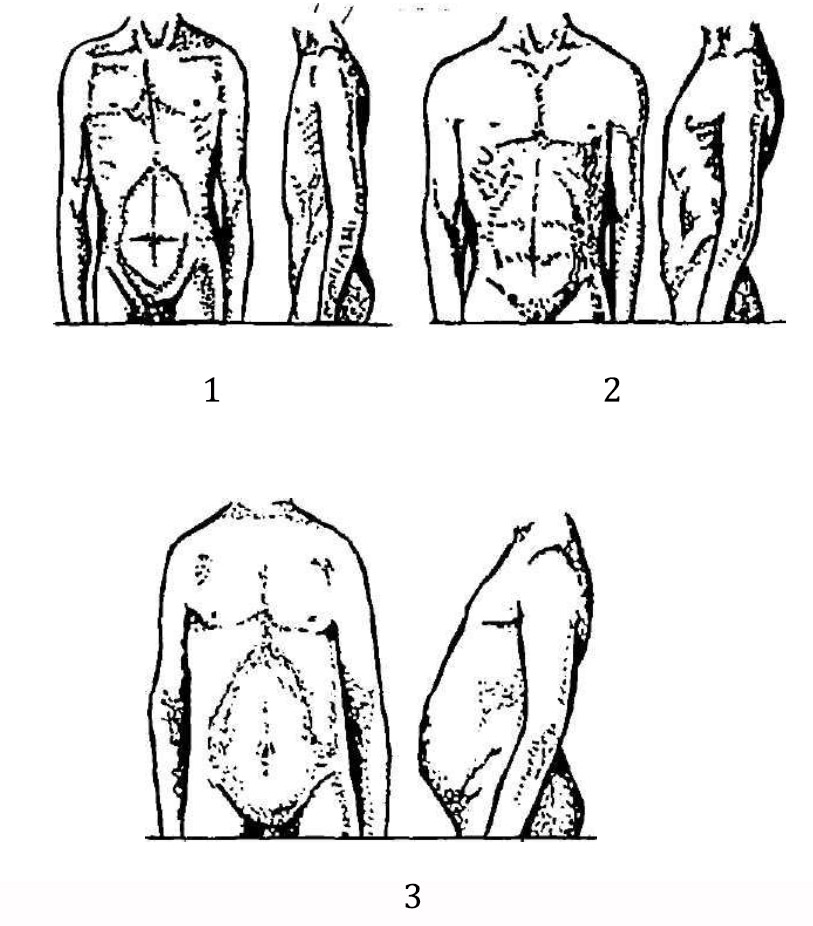 Формы грудной клетки и живота по Бунаку 