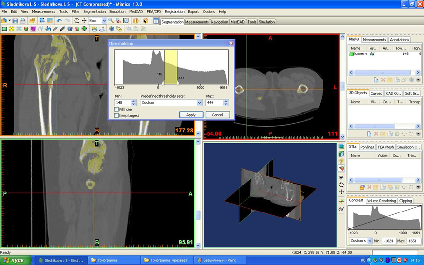 Использование программы Mimics при изучении биомеханики бедренной кости