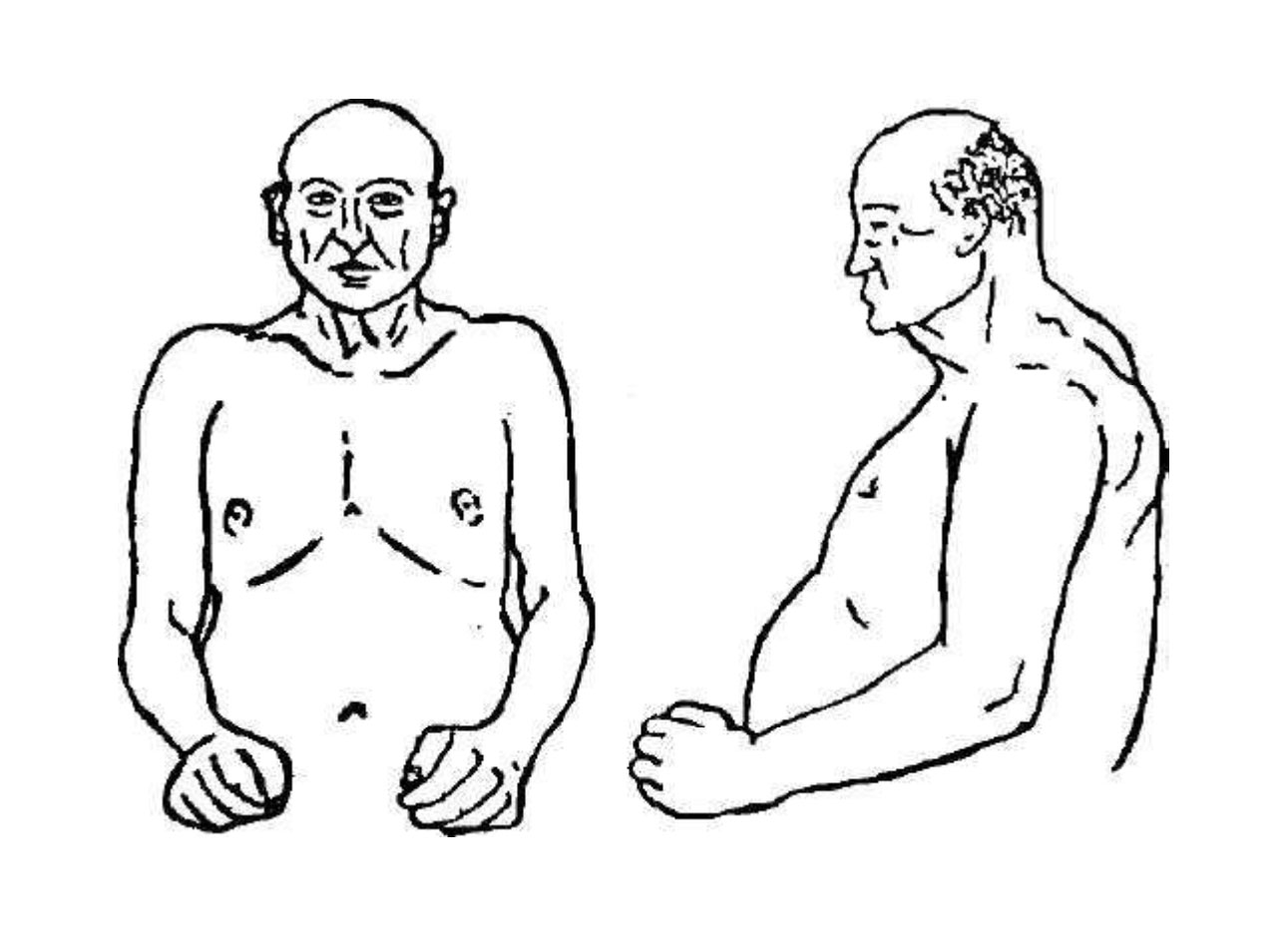 Пикнический тип по Э. Кречмеру