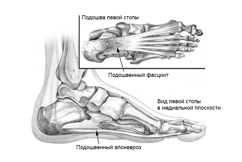 Плантарная фасция и плантарный фасциит
