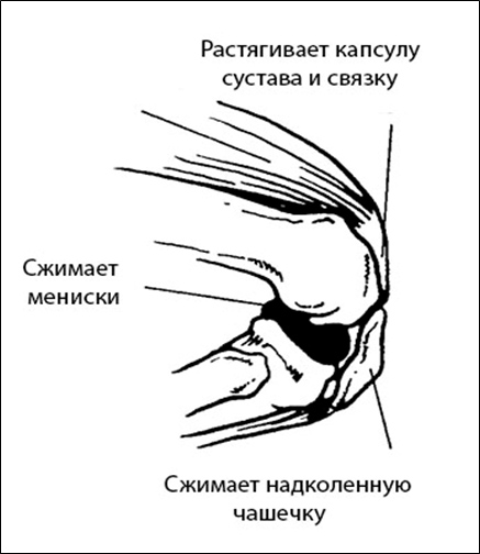 Схема функционирования коленного сустава при сильном сгибании [5]
