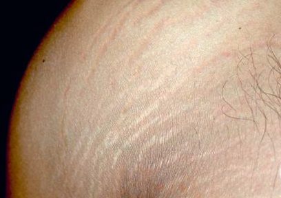 Миниатюра для записи Эффект введения инсулина на быстрые и медленные мышечные волокна бодибилдеров и больных сахарным диабетом