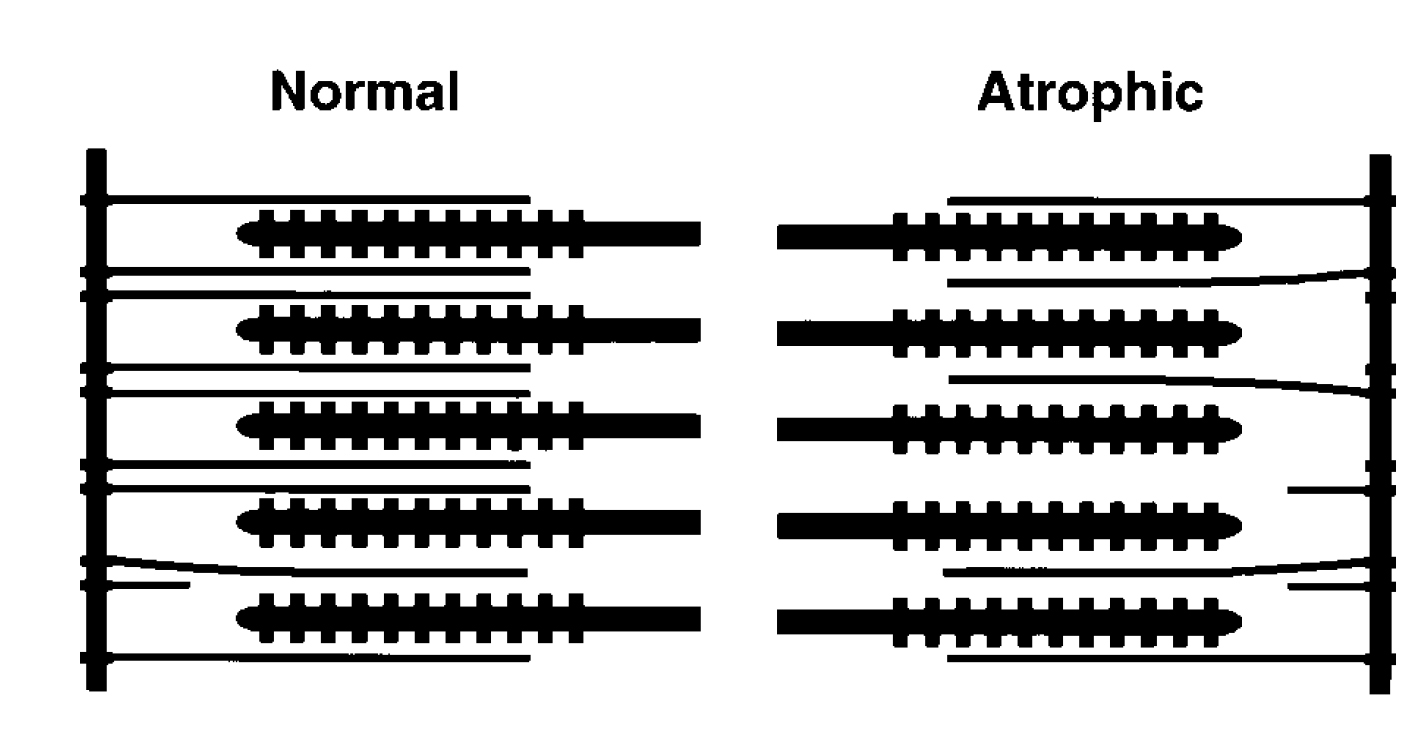 Схематическое представление расположения толстых и тонких филаментов до (слева) и после (справа) космического полета (D.A.Riley et al., 2000)