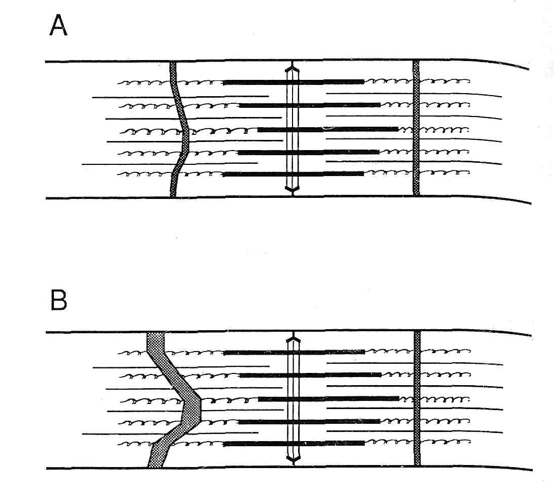 Повреждение Z-диска